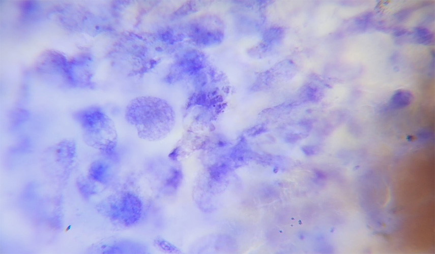 Adenocarcinoma – A malignant tumour of the gland.